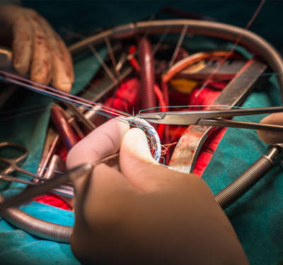 A suture valve ring is used during mitral valve repair surgery.
