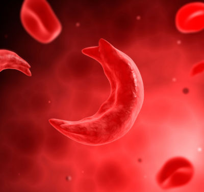 In sickle cell disease, the red blood cells become deformed into a crescent or sickle shape.