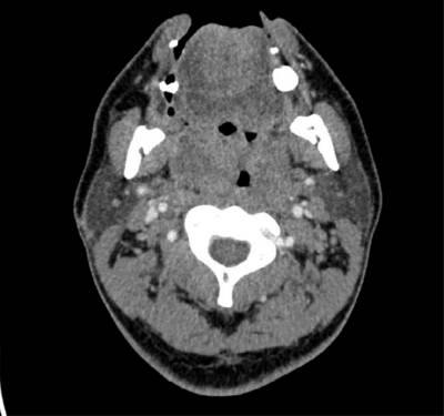 Axial cut of contrasted CT showing collections of fluid within bilateral enlarged tonsils.