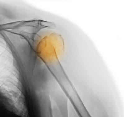 X-ray of the shoulder of an 81 year old woman with osteoporosis showing a fracture of the head of the humerus