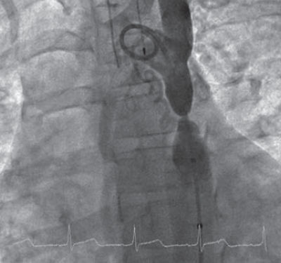 Inserting a metal tube to widen the aorta can be a life-saving procedure for a common lesion that causes narrowing of the important artery.