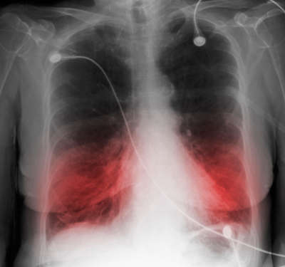 A chest x-ray of an elderly smoker with COPD.