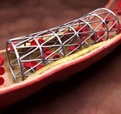 Close-up view of a coronary stent.